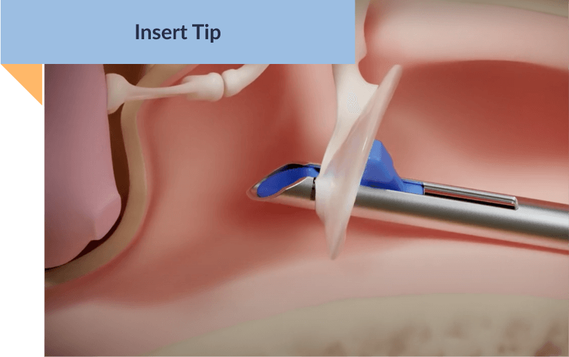 graphic of the ear canal with the hummingbird device tip being inserted