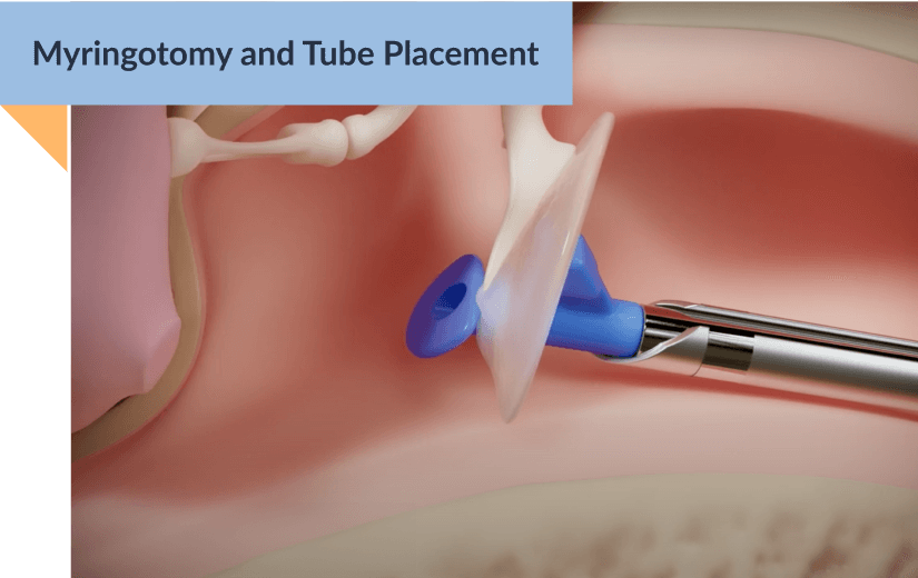 graphic of the ear canal with the hummingbird device placing the ear tube