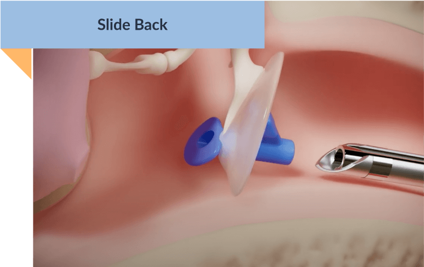 graphic of the ear canal with ear tube inserted and hummingbird device sliding back
