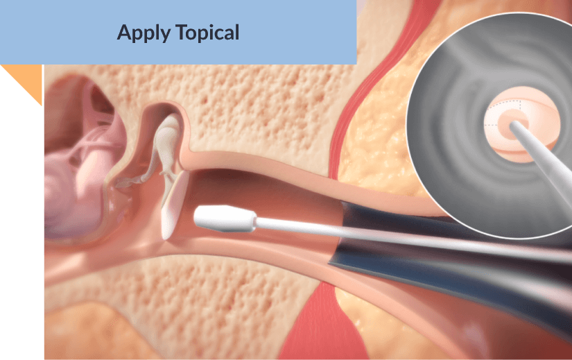 graphic of the ear canal with topical anesthetic being applied